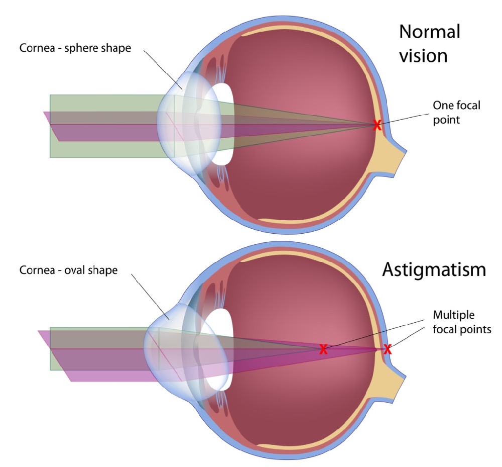 VisualEyes Optometrists - Astigmatism