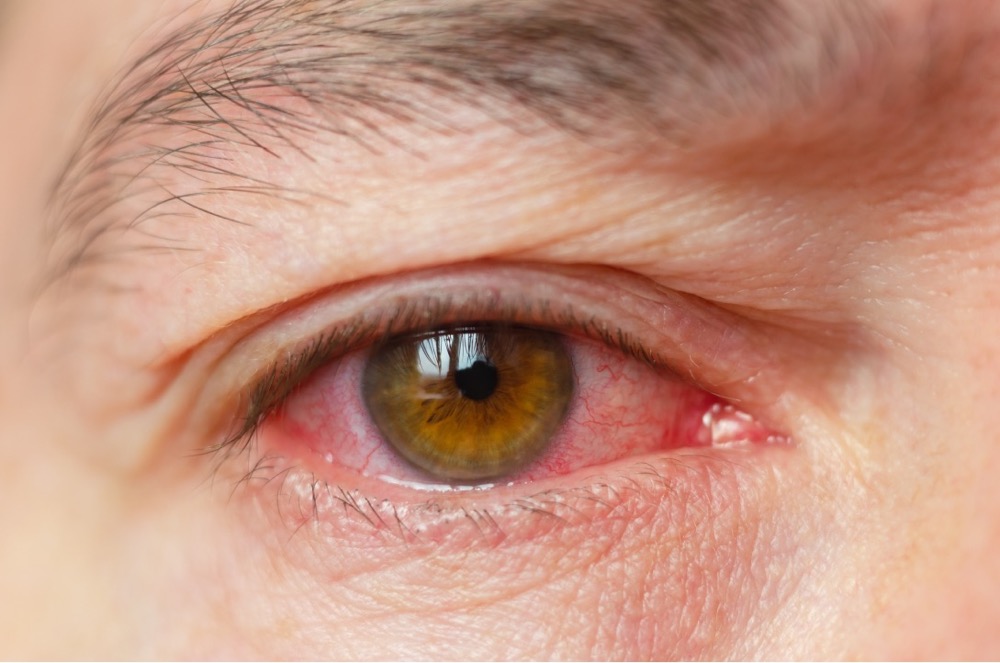 VisualEyes Optometrists - Red Eye
